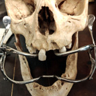 Kirurginen suunlevitin (Molt Mouth Gag), Eurooppa - pikkukuva 3
